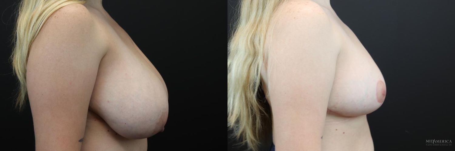 Breast Reduction Before & After