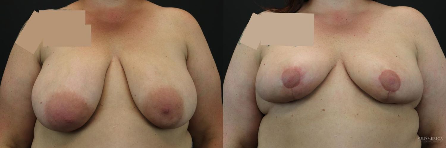 Breast Reduction Before & After