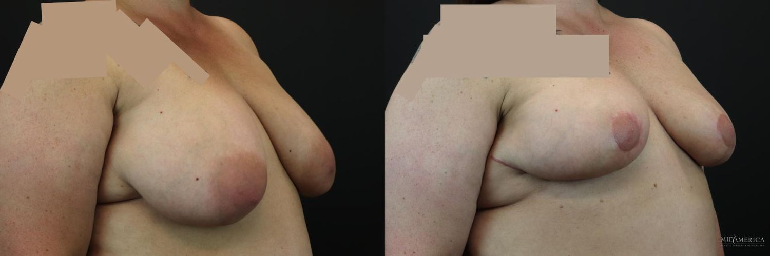 Breast Reduction Before & After