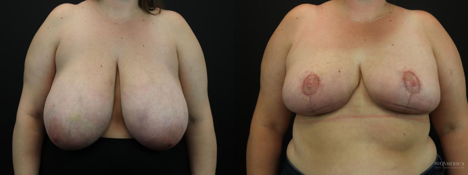 Breast Reduction Before & After