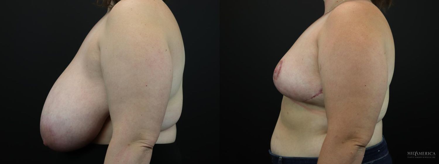 Breast Reduction Before & After