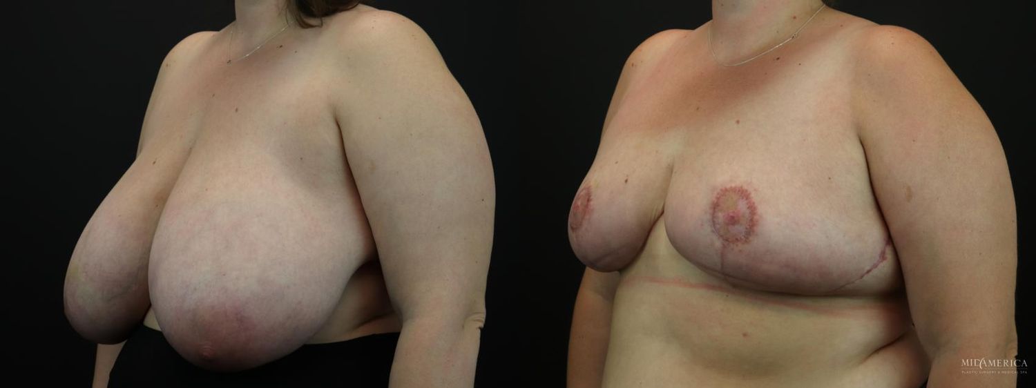Breast Reduction Before & After