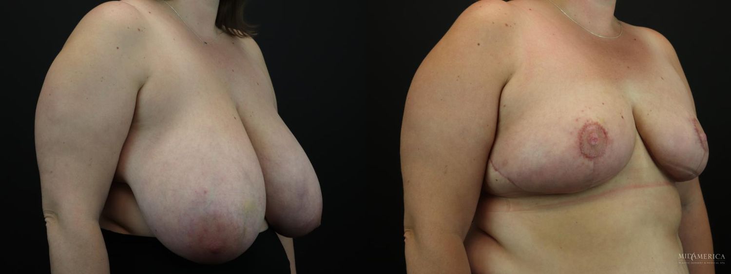 Breast Reduction Before & After