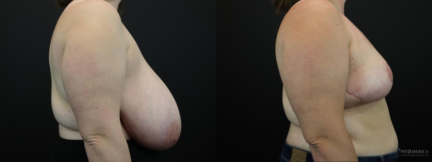 Breast Reduction Before & After