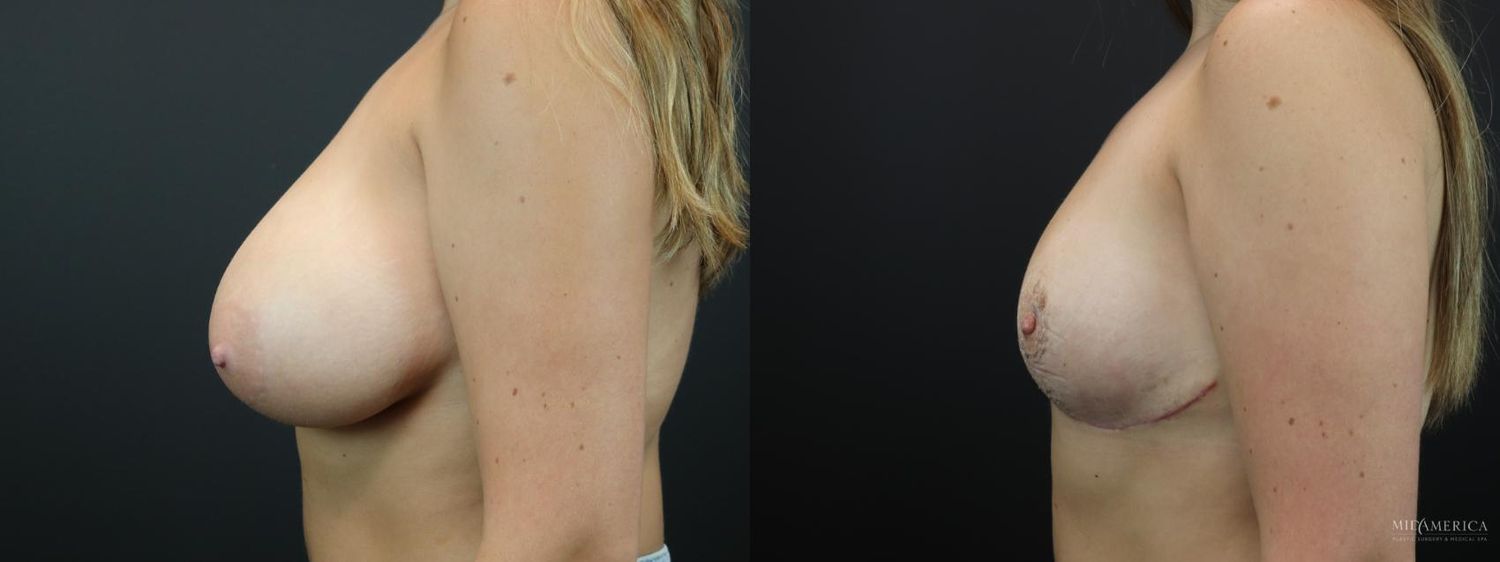 Breast Reduction Before & After