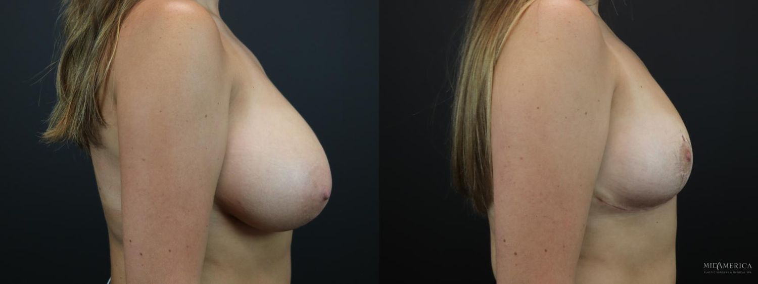 Breast Reduction Before & After