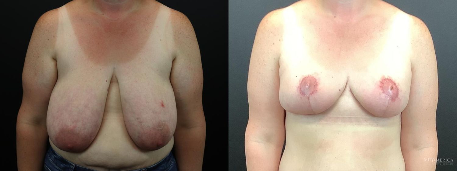 Breast Reduction Before & After