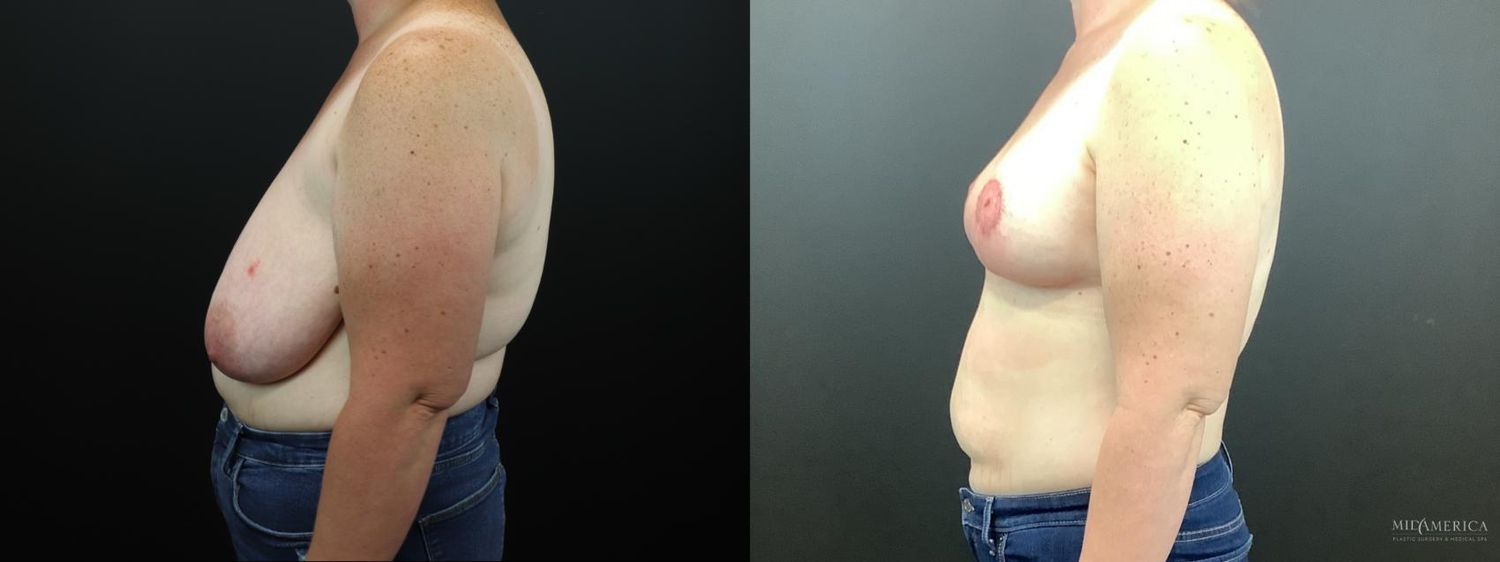 Breast Reduction Before & After