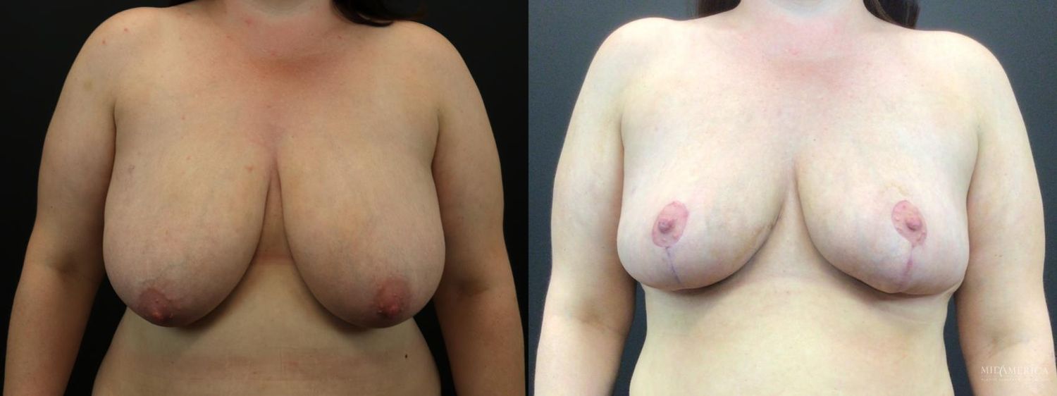 Breast Reduction Before & After