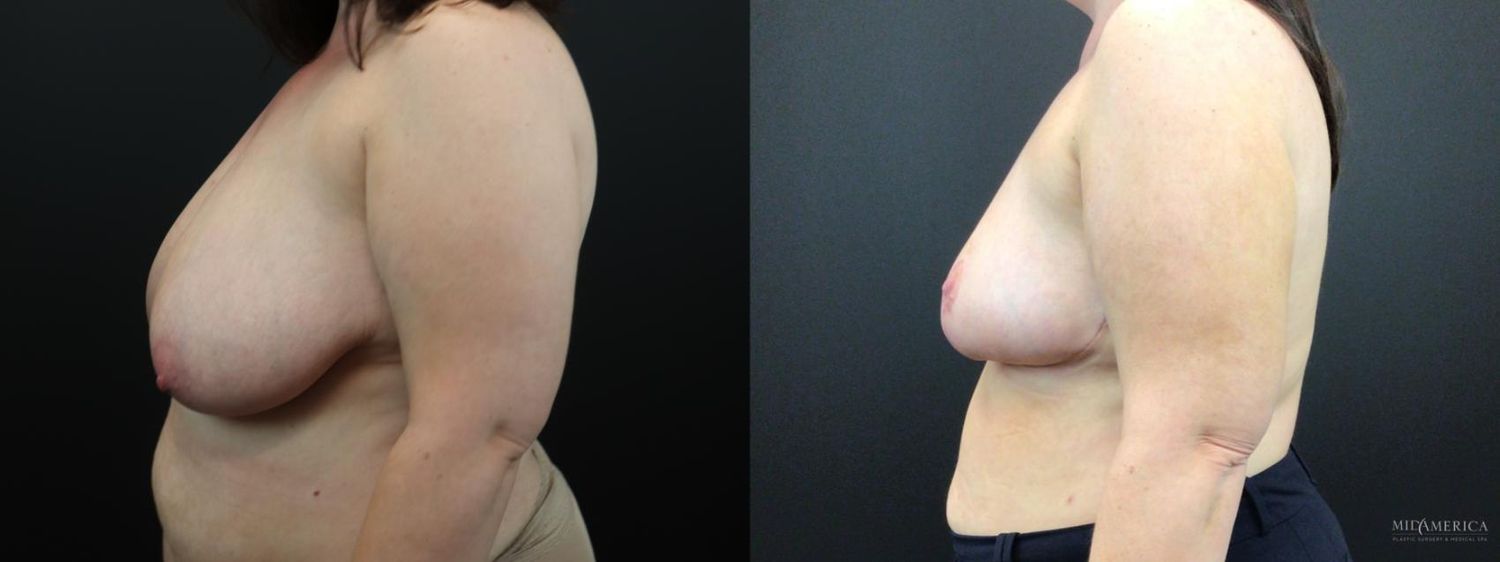 Breast Reduction Before & After