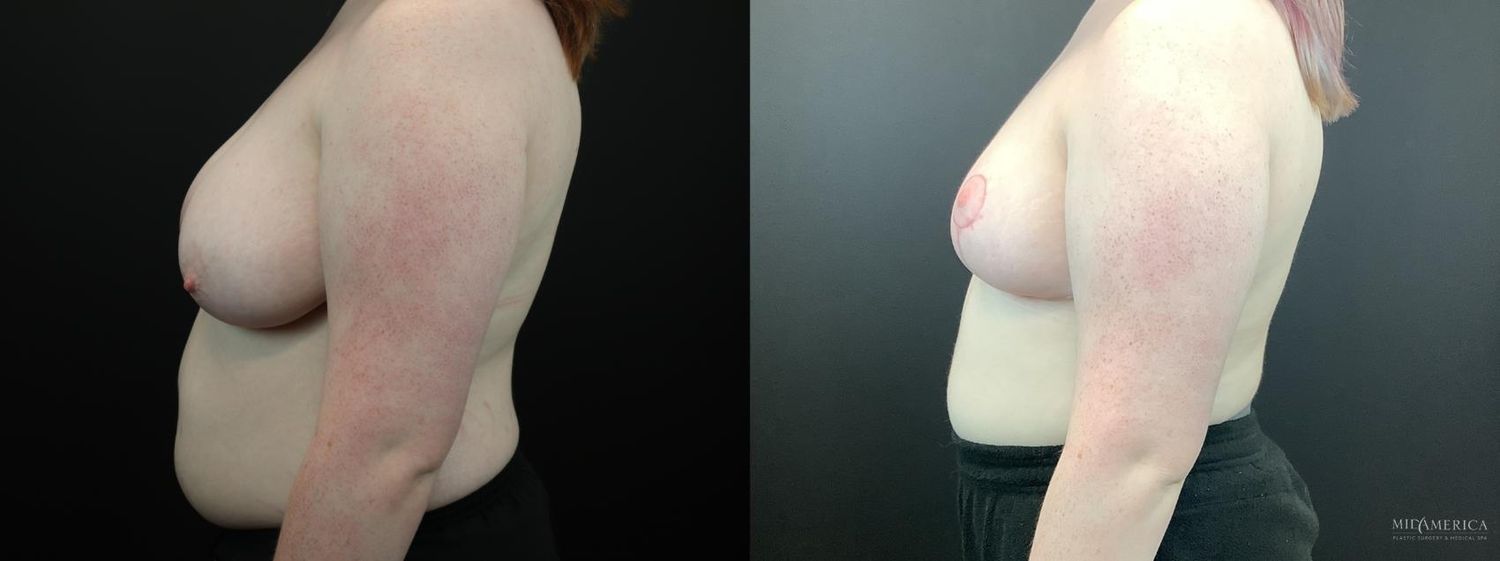 Breast Reduction Before & After