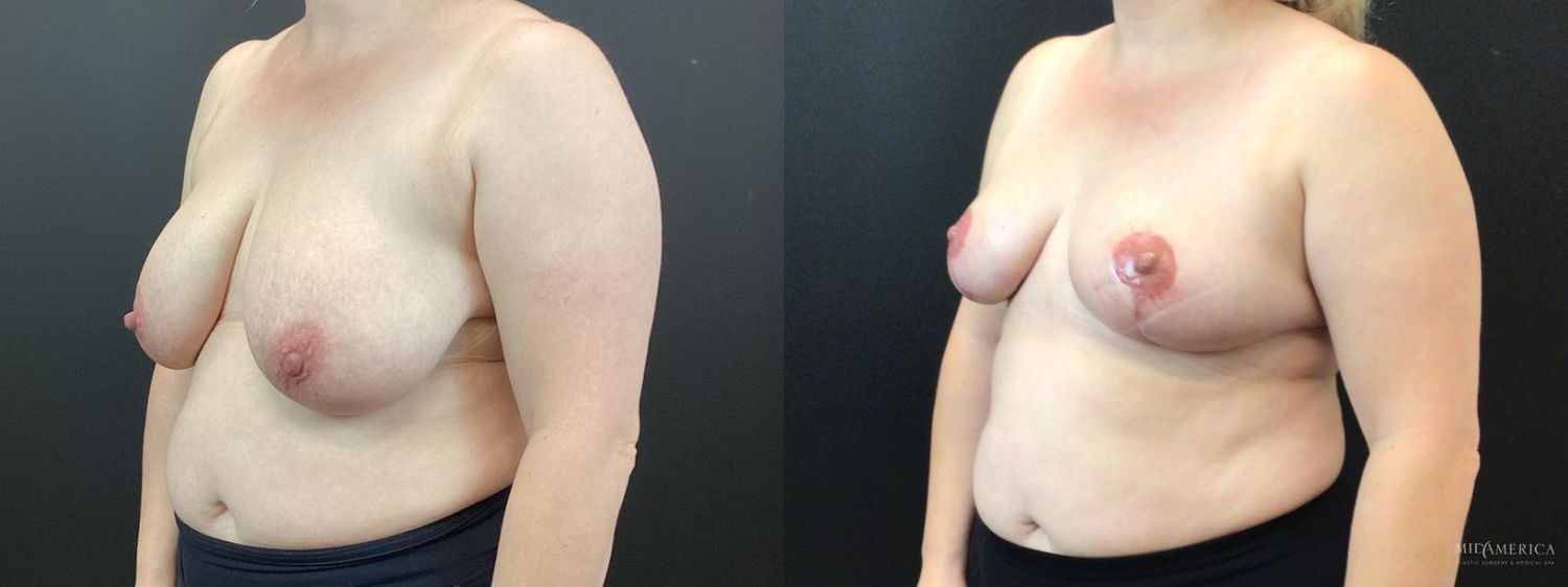 Breast Reduction Before & After