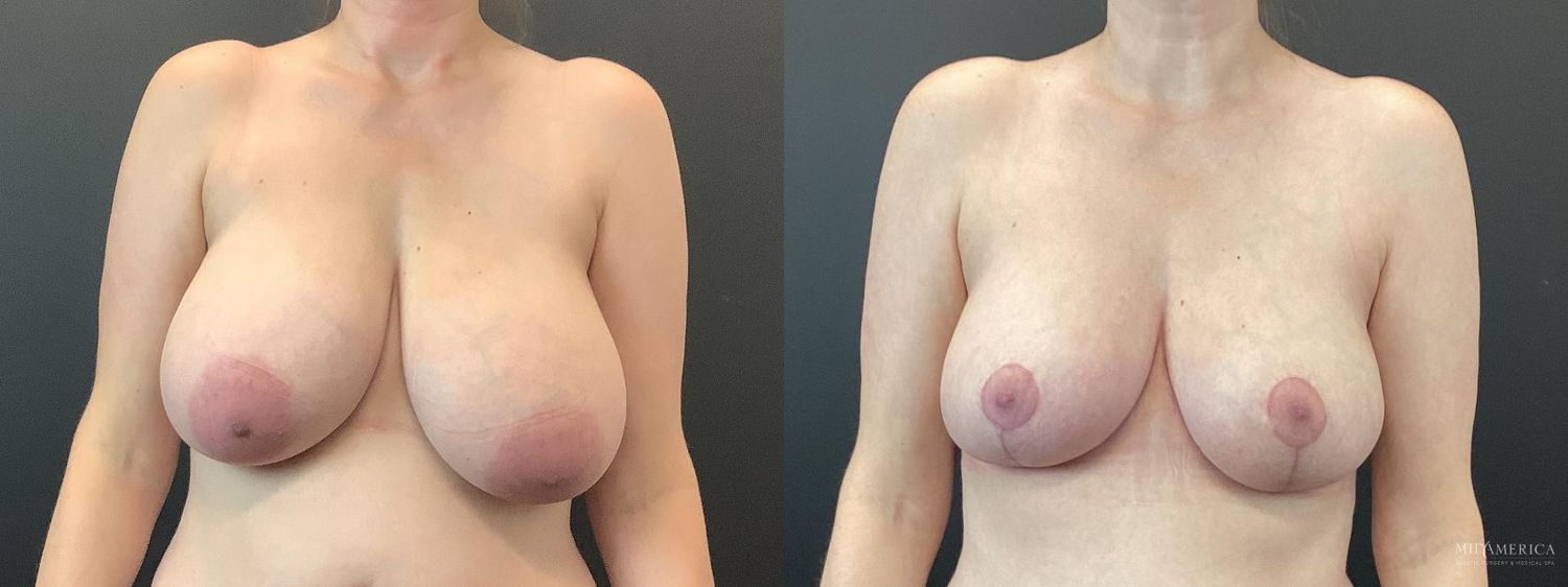 Breast Reduction Before & After