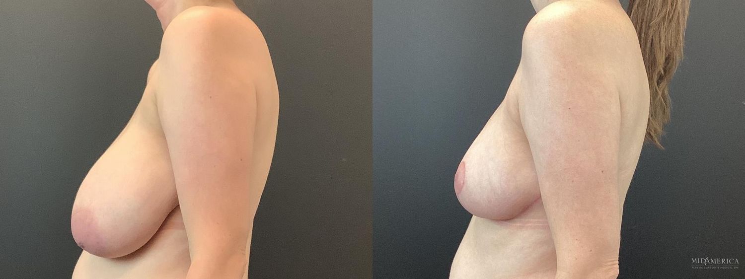 Breast Reduction Before & After