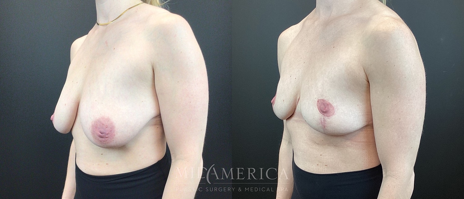 Breast Reduction Before & After