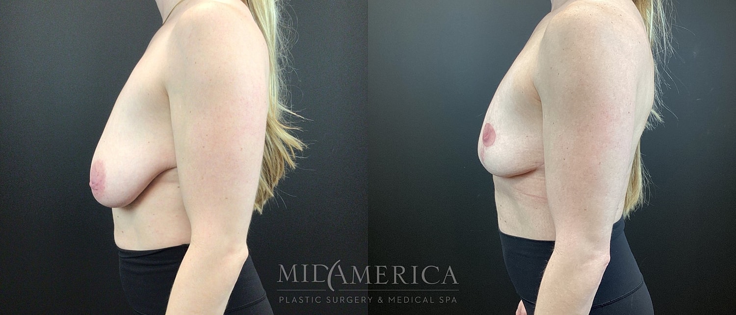 Breast Reduction Before & After