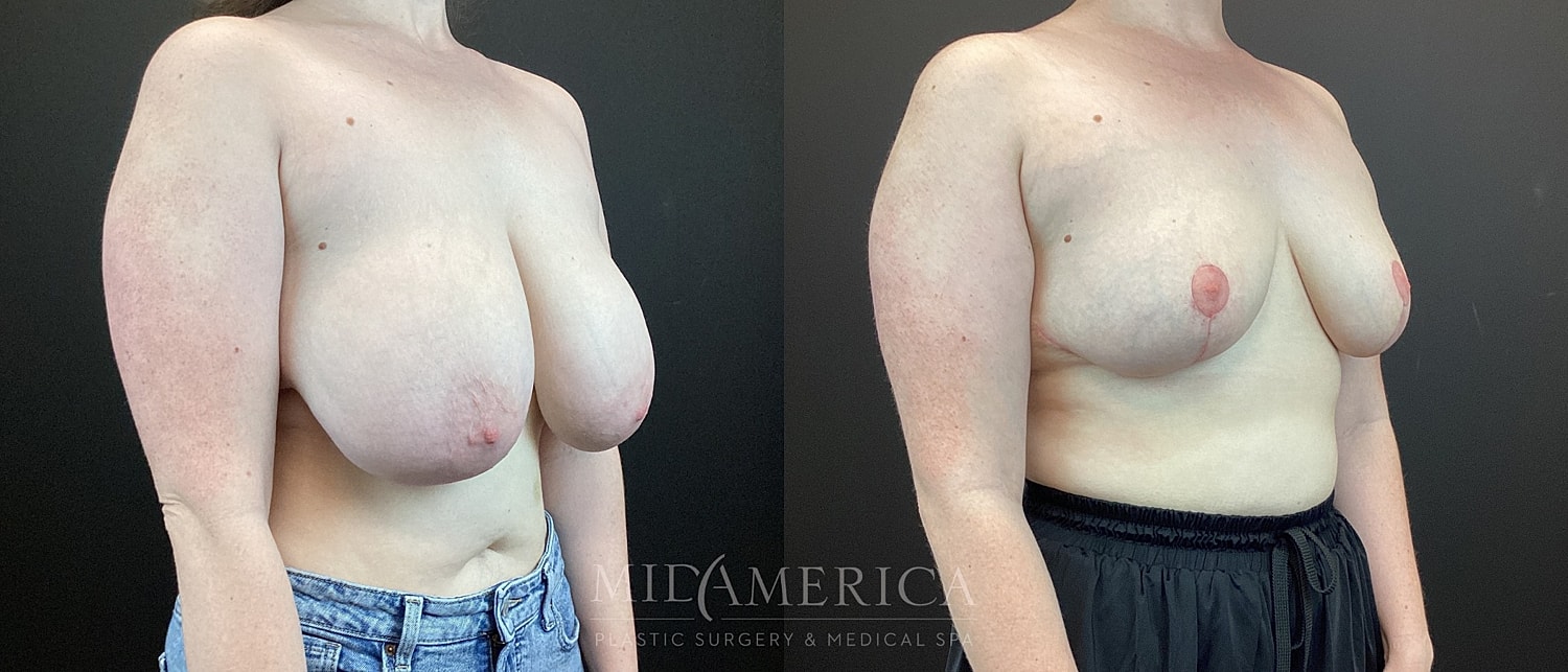 Breast Reduction Before & After