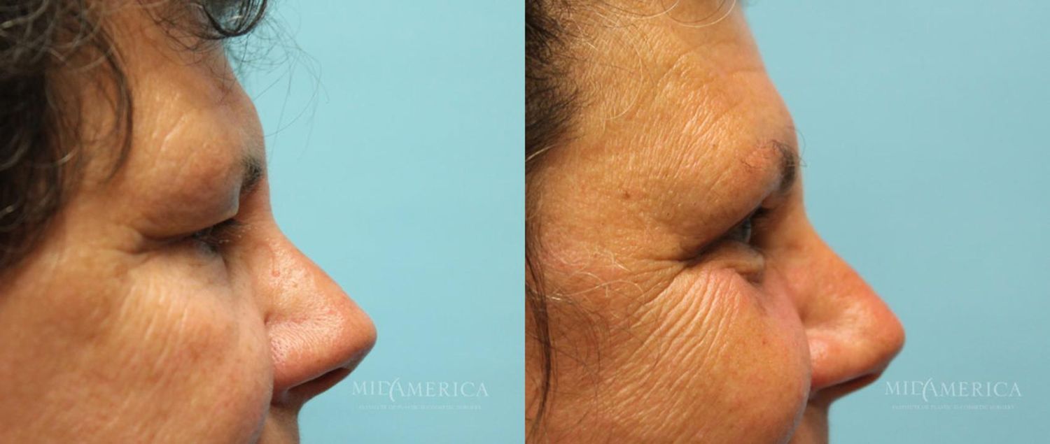 Eyelid Surgery Before & After