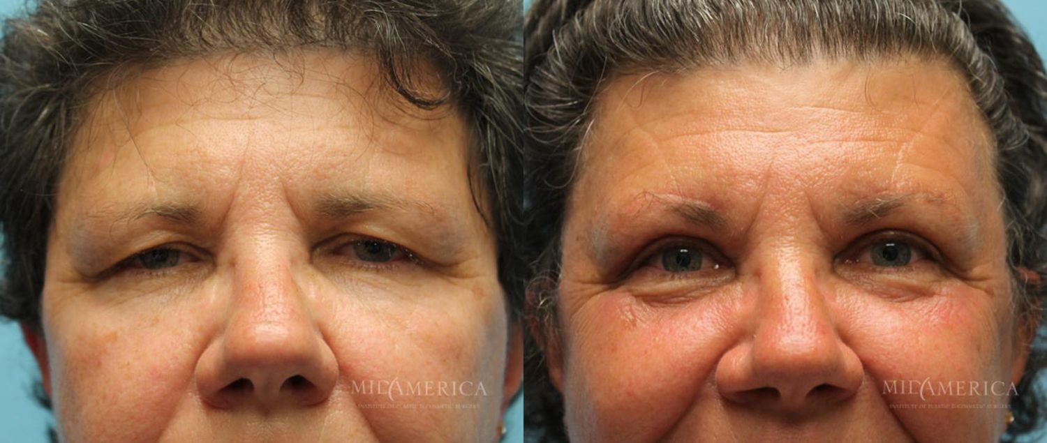 Eyelid Surgery Before & After