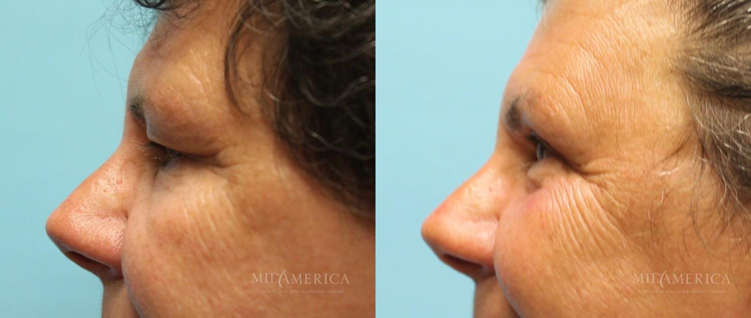 Eyelid Surgery Before & After