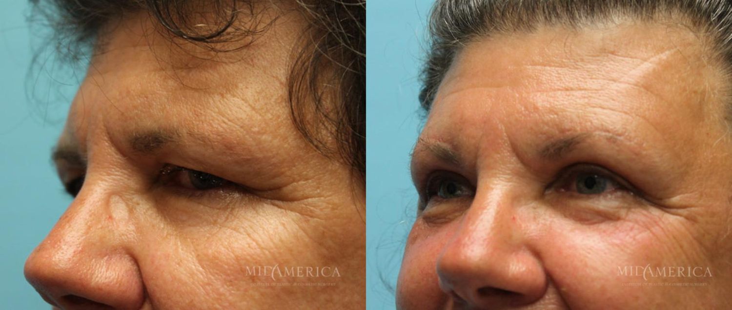 Eyelid Surgery Before & After