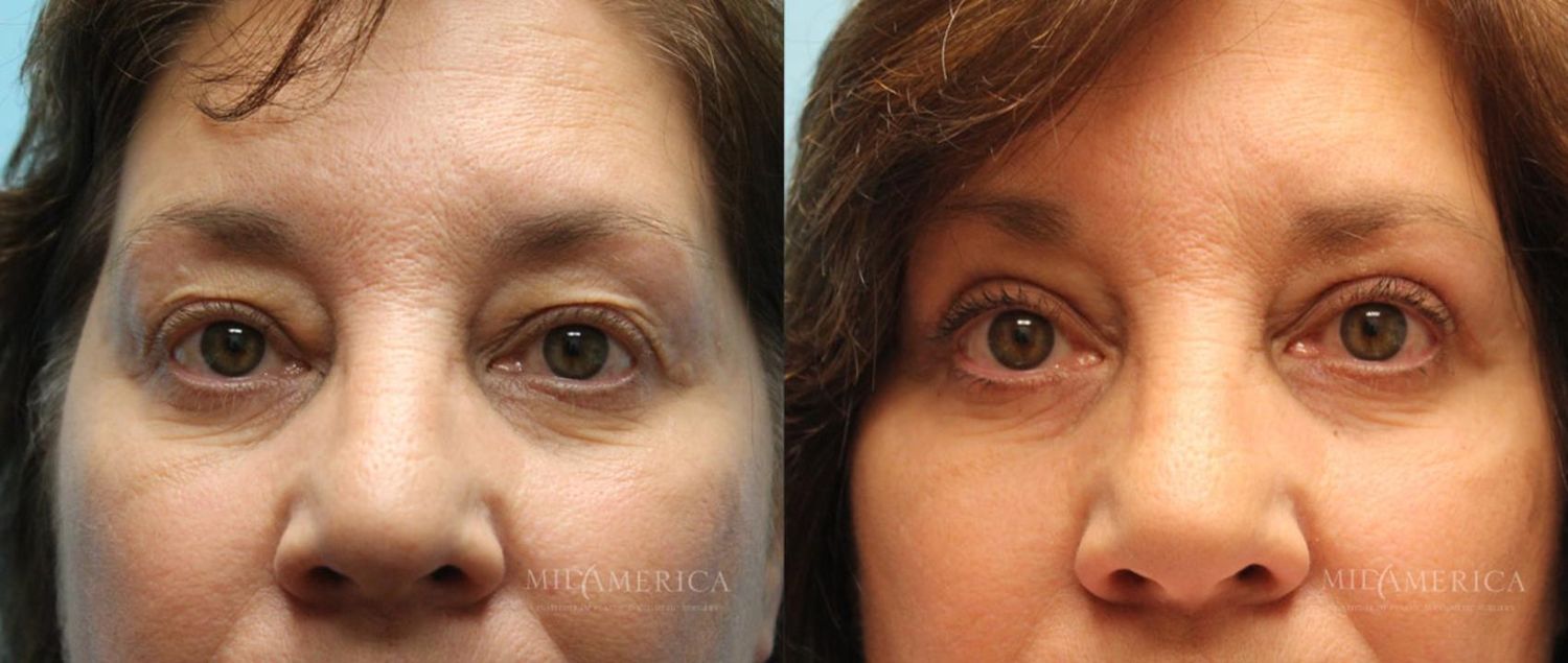 Eyelid Surgery Before & After