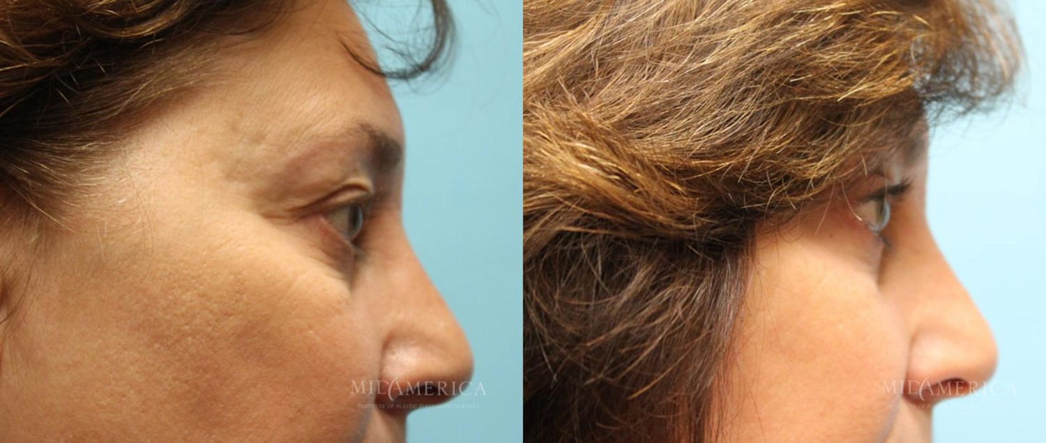 Eyelid Surgery Before & After