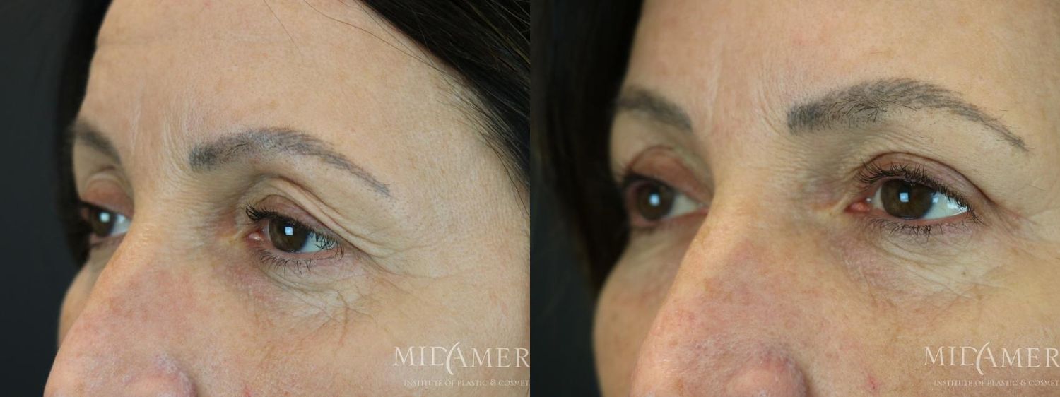 Eyelid Surgery Before & After