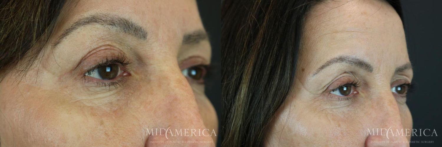 Eyelid Surgery Before & After