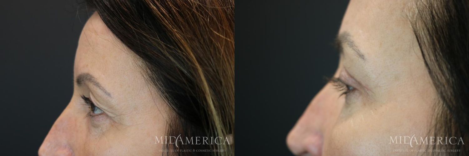 Eyelid Surgery Before & After