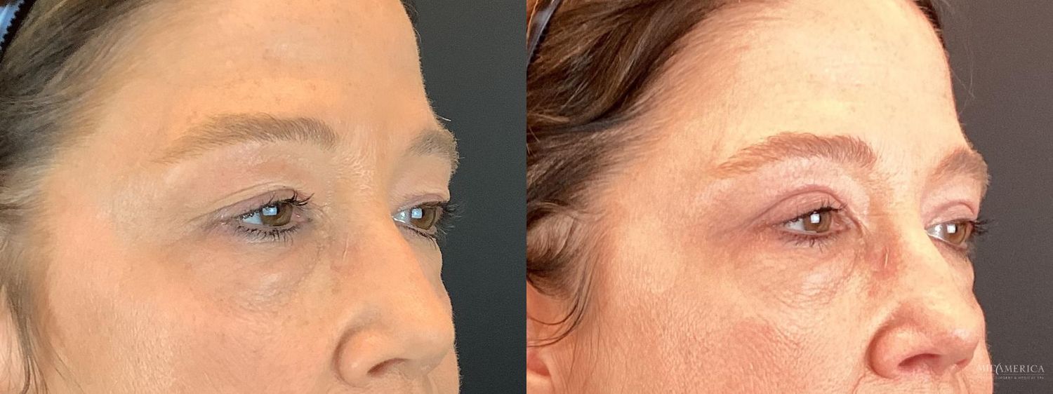 Eyelid Surgery Before & After