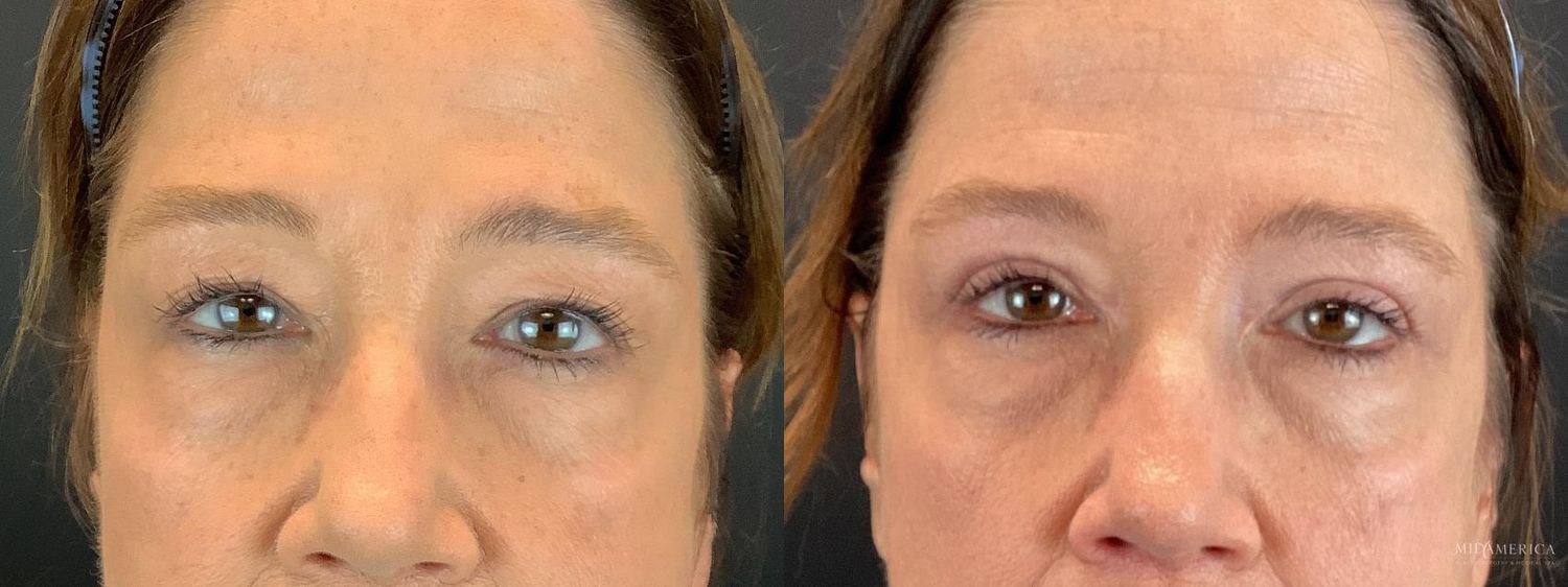 Eyelid Surgery Before & After