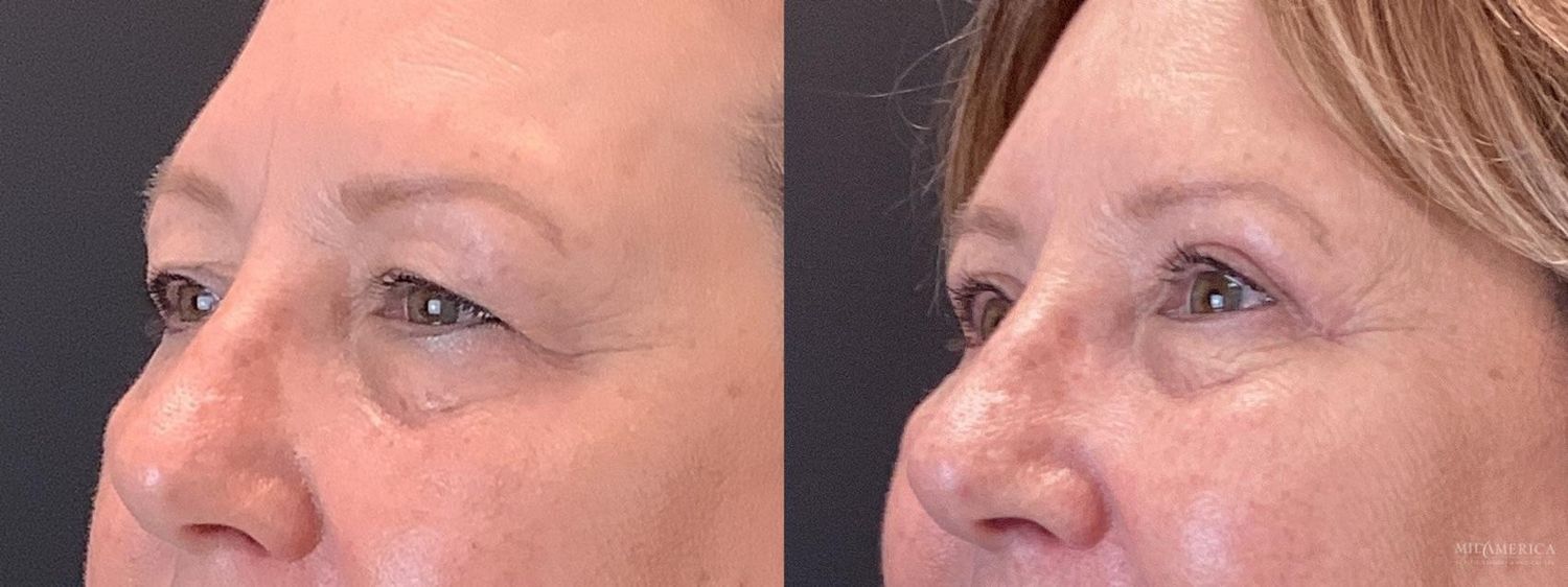 Eyelid Surgery Before & After