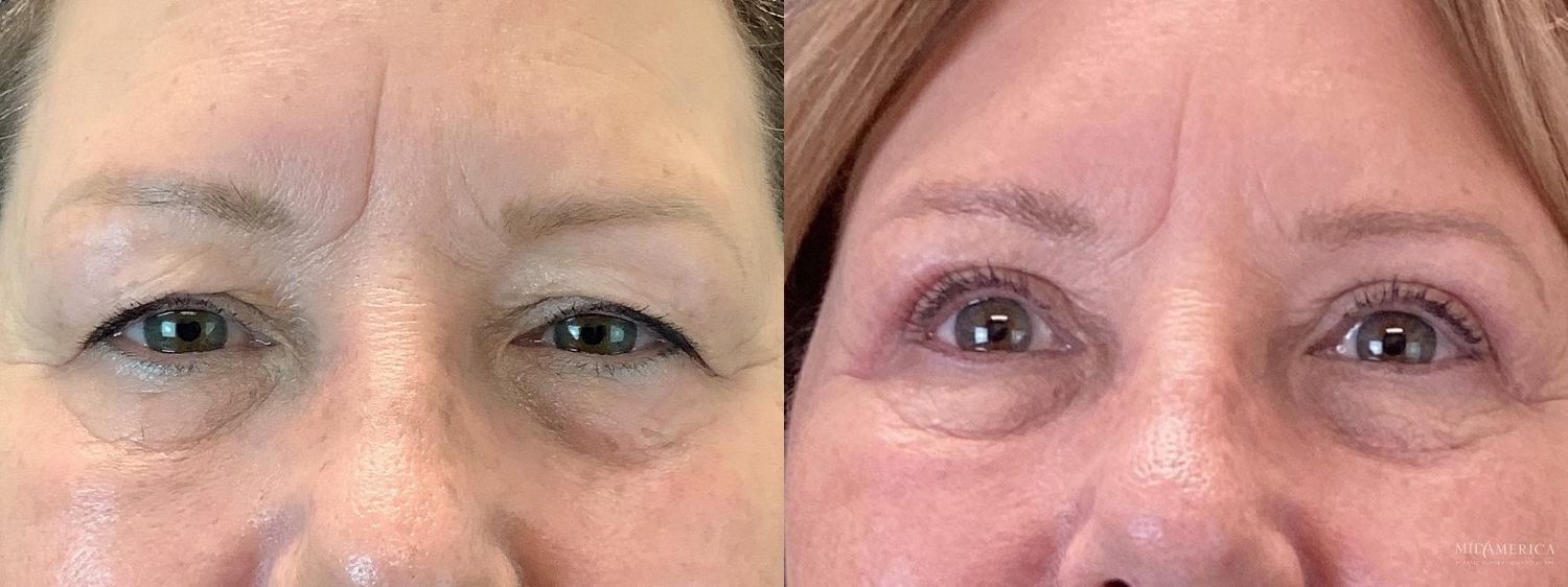 Eyelid Surgery Before & After