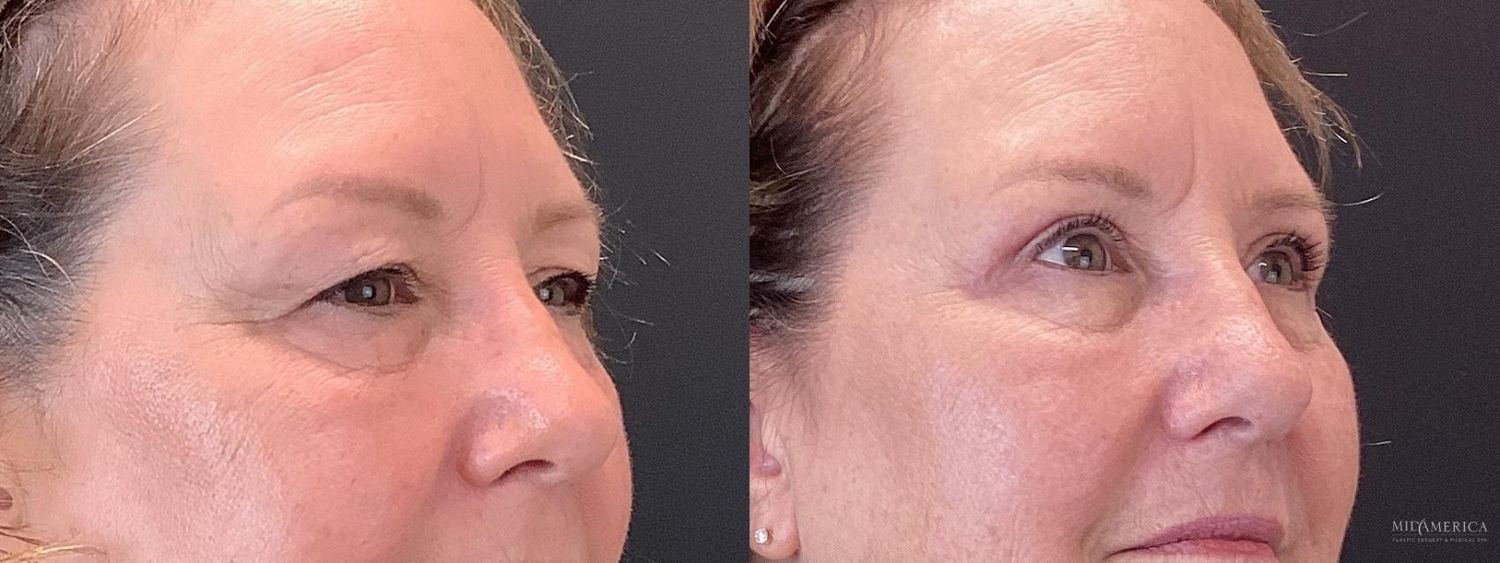 Eyelid Surgery Before & After