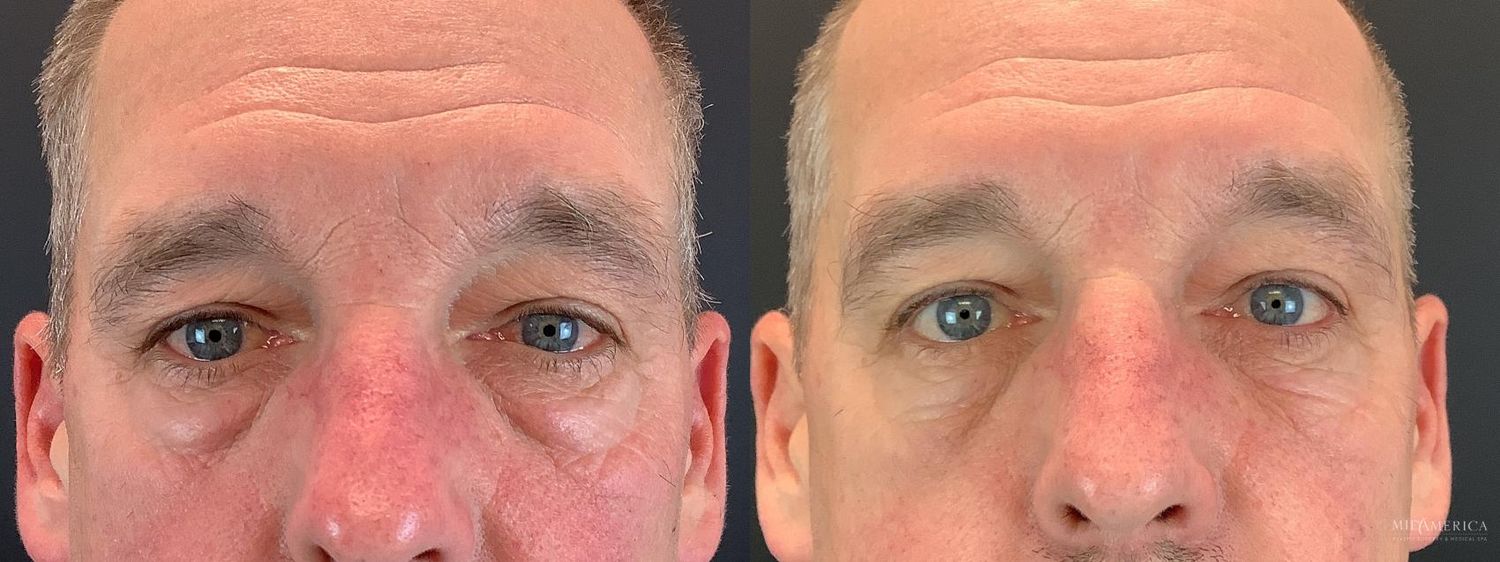 Eyelid Surgery Before & After