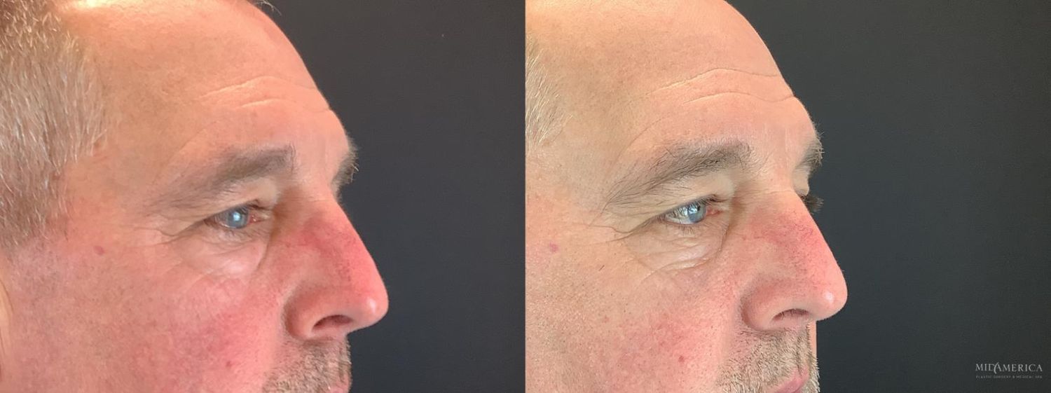 Eyelid Surgery Before & After