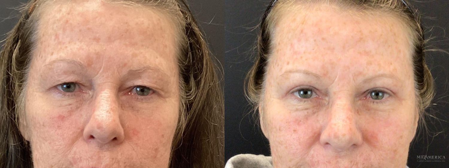 Eyelid Surgery Before & After