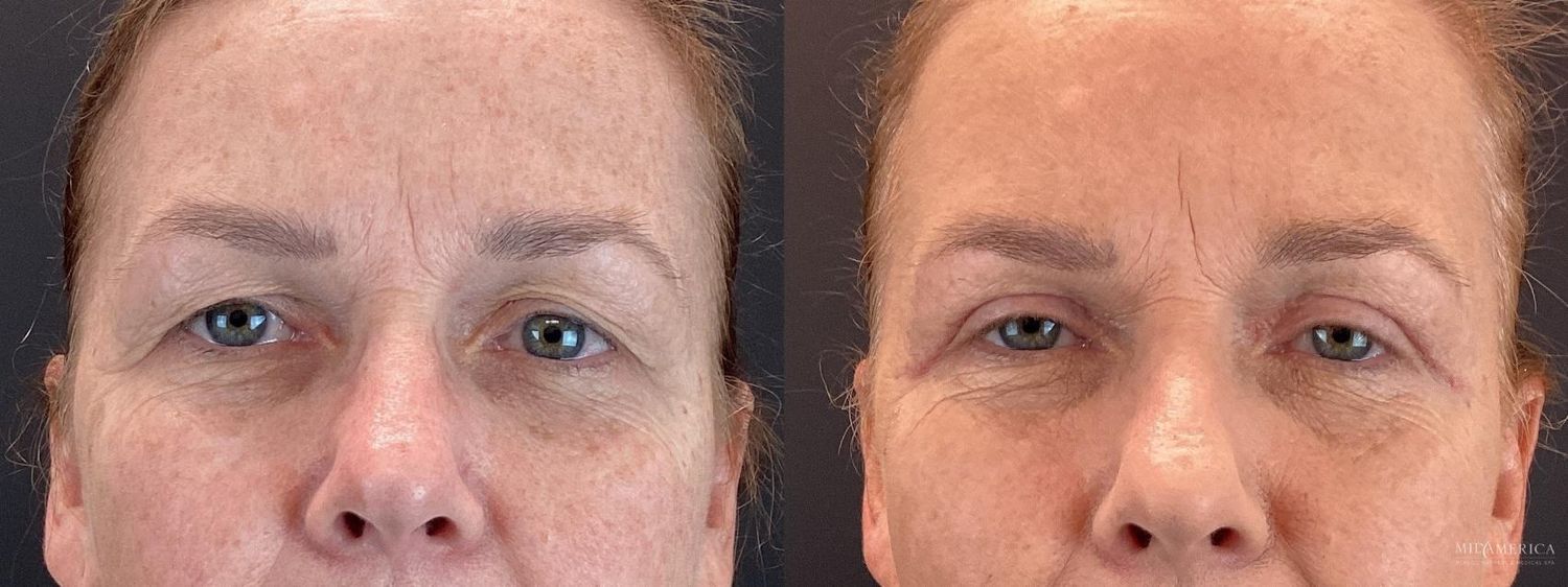 Eyelid Surgery Before & After