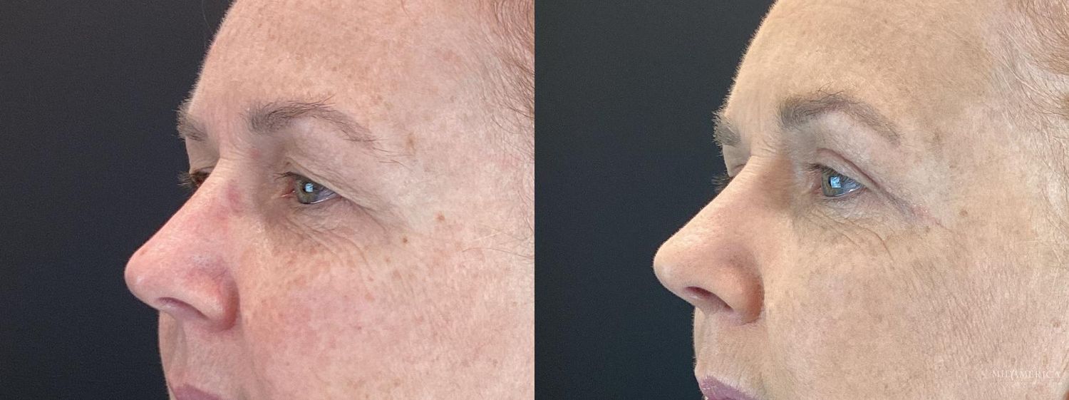 Eyelid Surgery Before & After