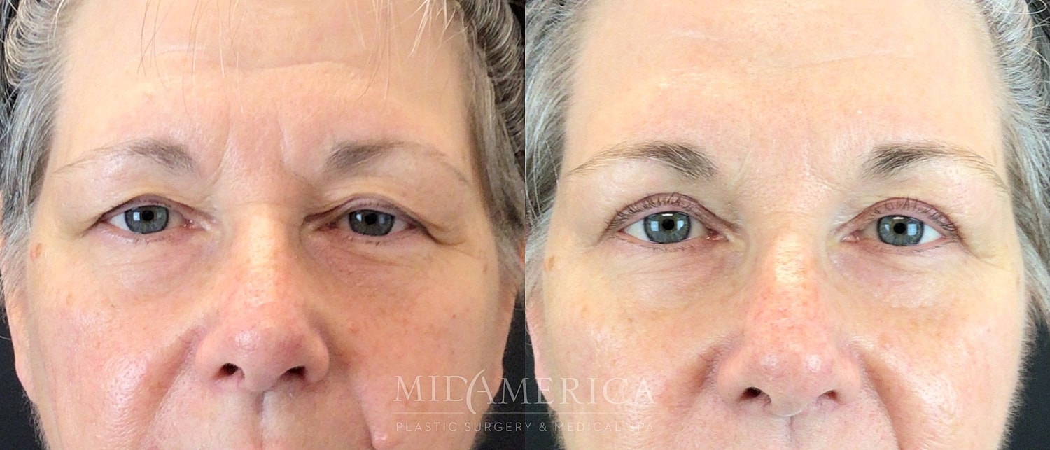 Eyelid Surgery Before & After