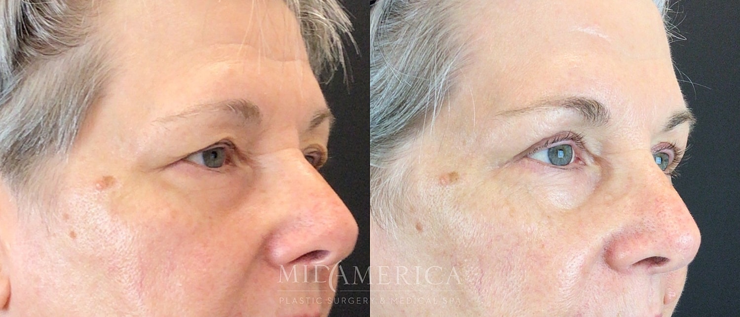 Eyelid Surgery Before & After