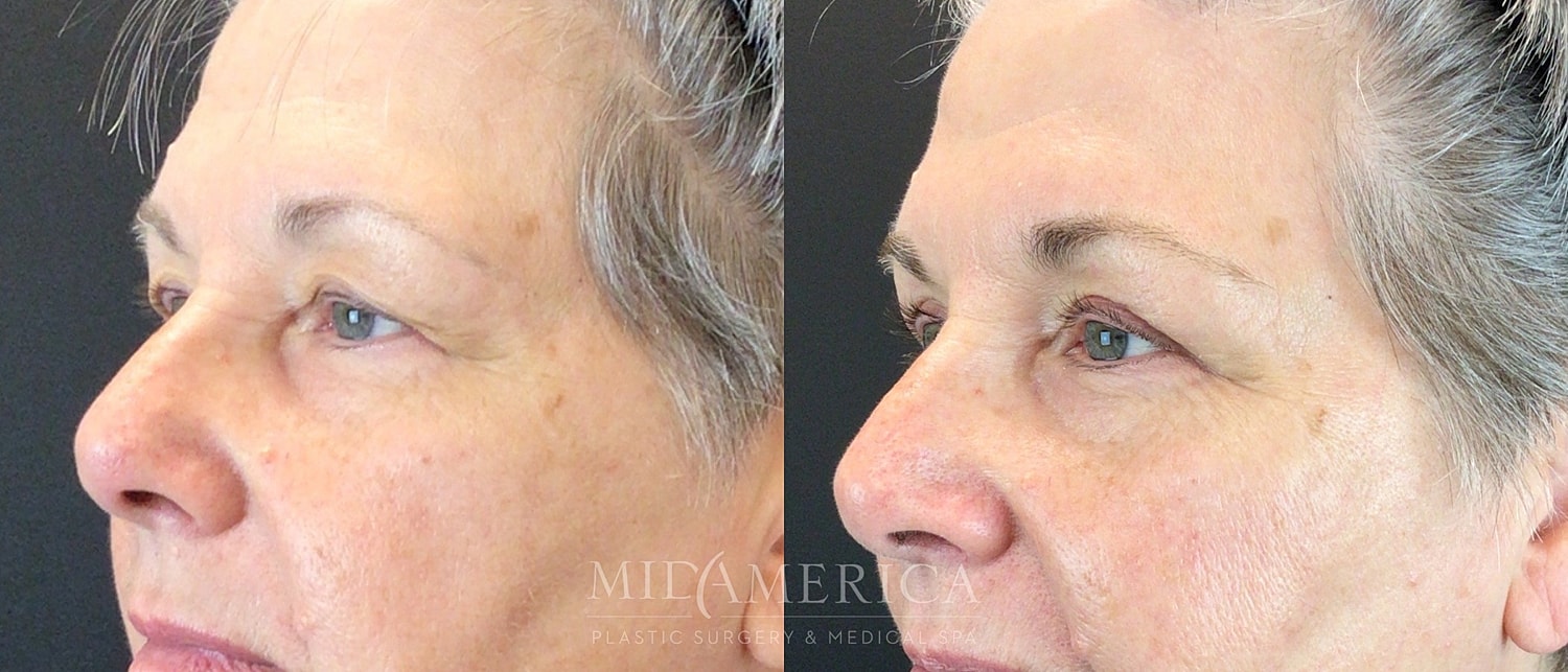 Eyelid Surgery Before & After