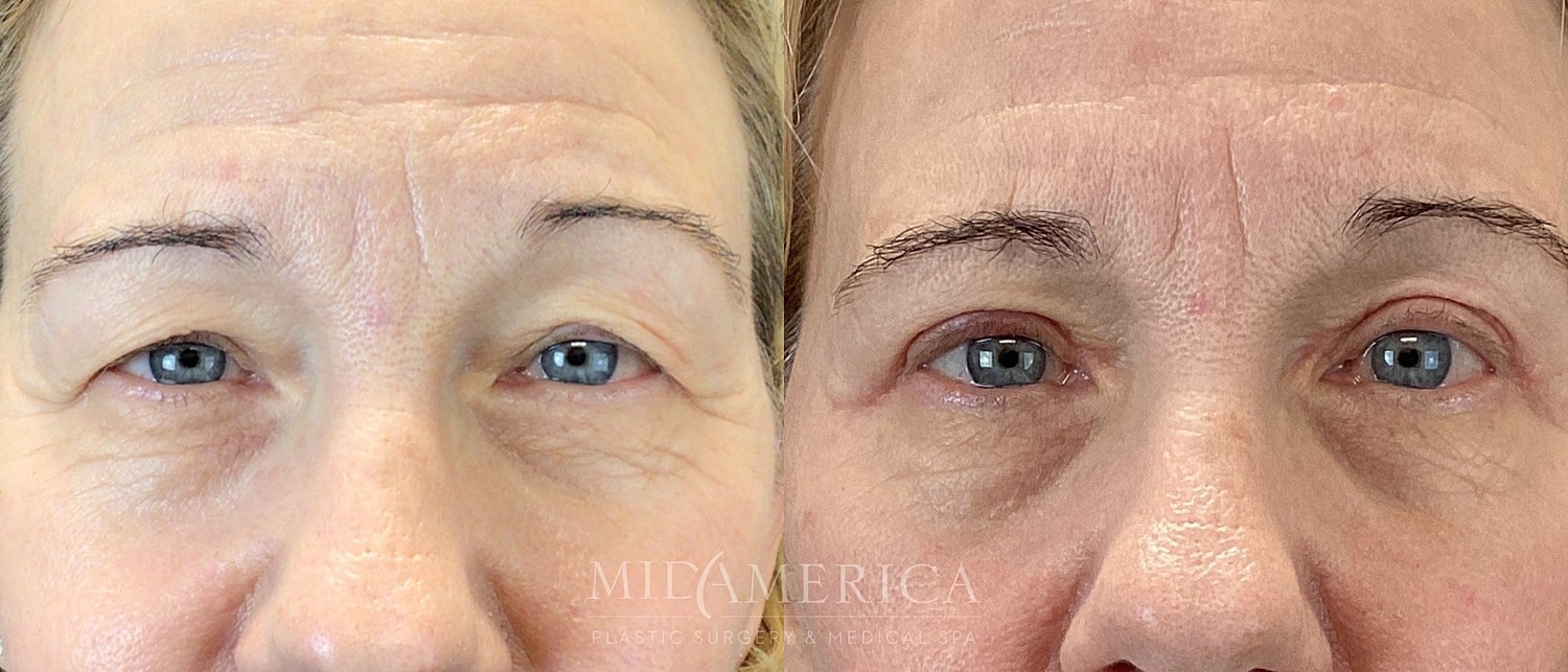 Eyelid Surgery Before & After