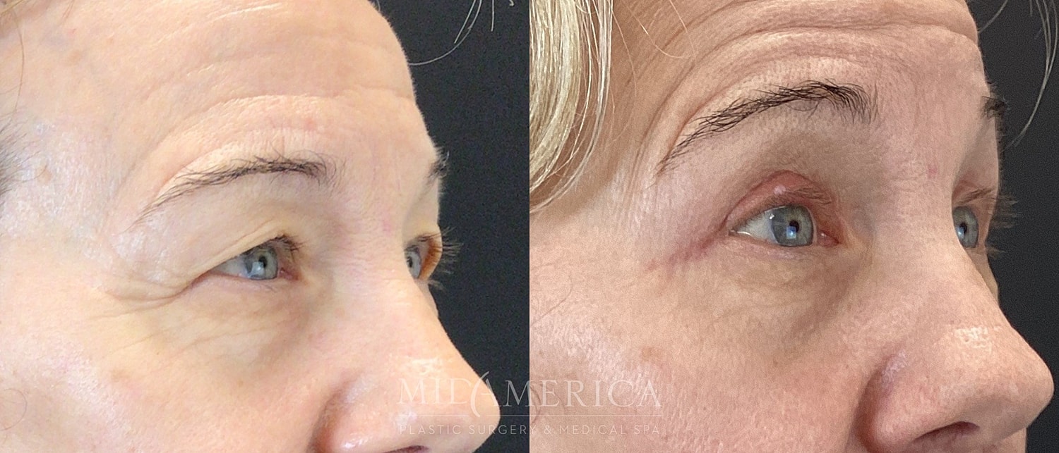 Eyelid Surgery Before & After