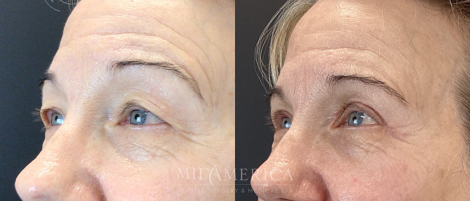Eyelid Surgery Before & After