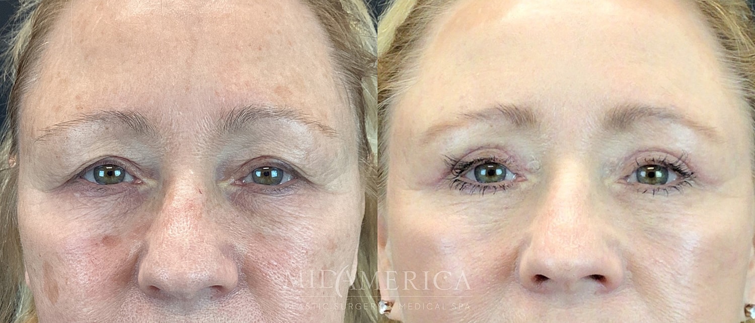 Eyelid Surgery Before & After