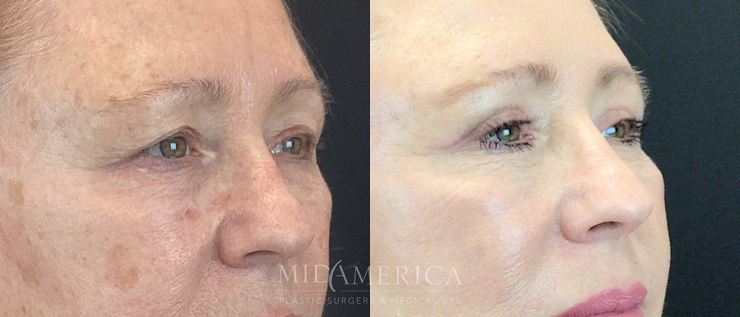Eyelid Surgery Before & After