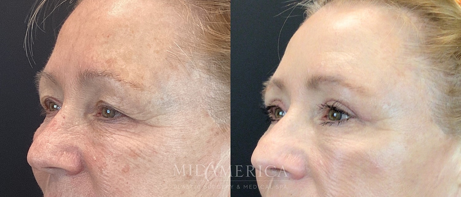 Eyelid Surgery Before & After