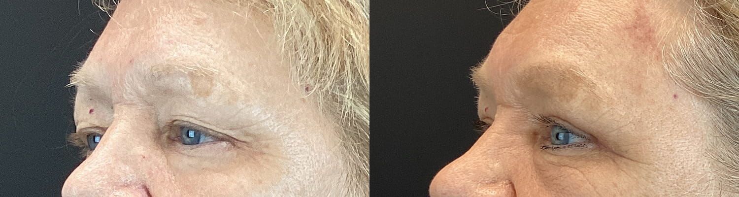 Eyelid Surgery Before & After